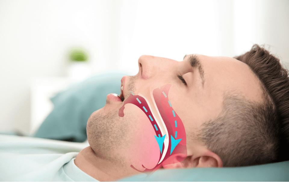 Oral Appliance Therapy: No Mask CPAP Alternative for Treatment of Sleep Apnea